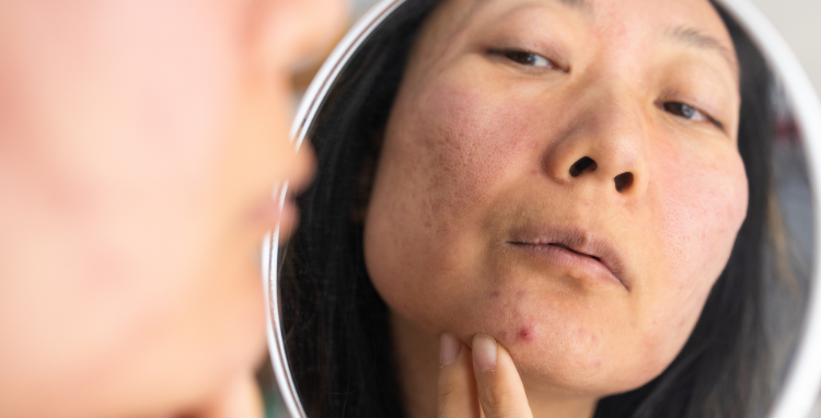 Peelings para acne: como atuar de forma inteligente em peles oleosas e acneicas