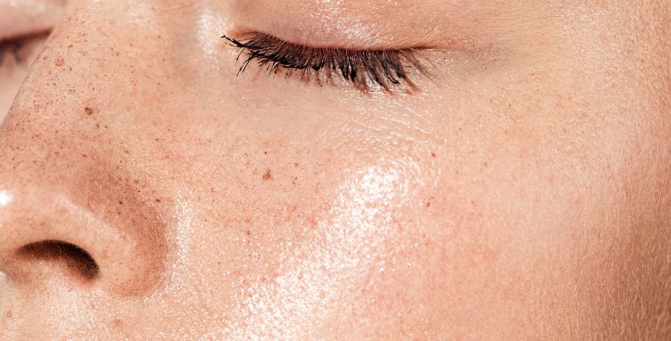 Pele oleosa: o guia definitivo para profissionais da estética