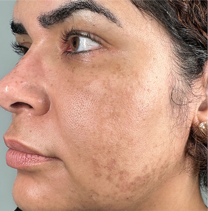 imagem de antes e depois